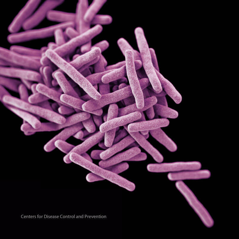 The spread of drug-resistant tuberculosis could undermine advancements in HIV and AIDS prevention. Photo: CDC. 